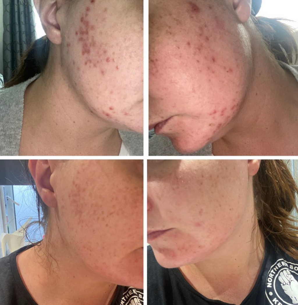 Breakout Kit | Skincare Routine for Blemish-Prone & Dehydrated Skin